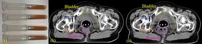 Rectum Protection by Rectal Gel Injection in Cervical Cancer Brachytherapy: A Dosimetric Study via Deformable Surface Dose Accumulation and Machine-Learning-Based Discriminative Modeling